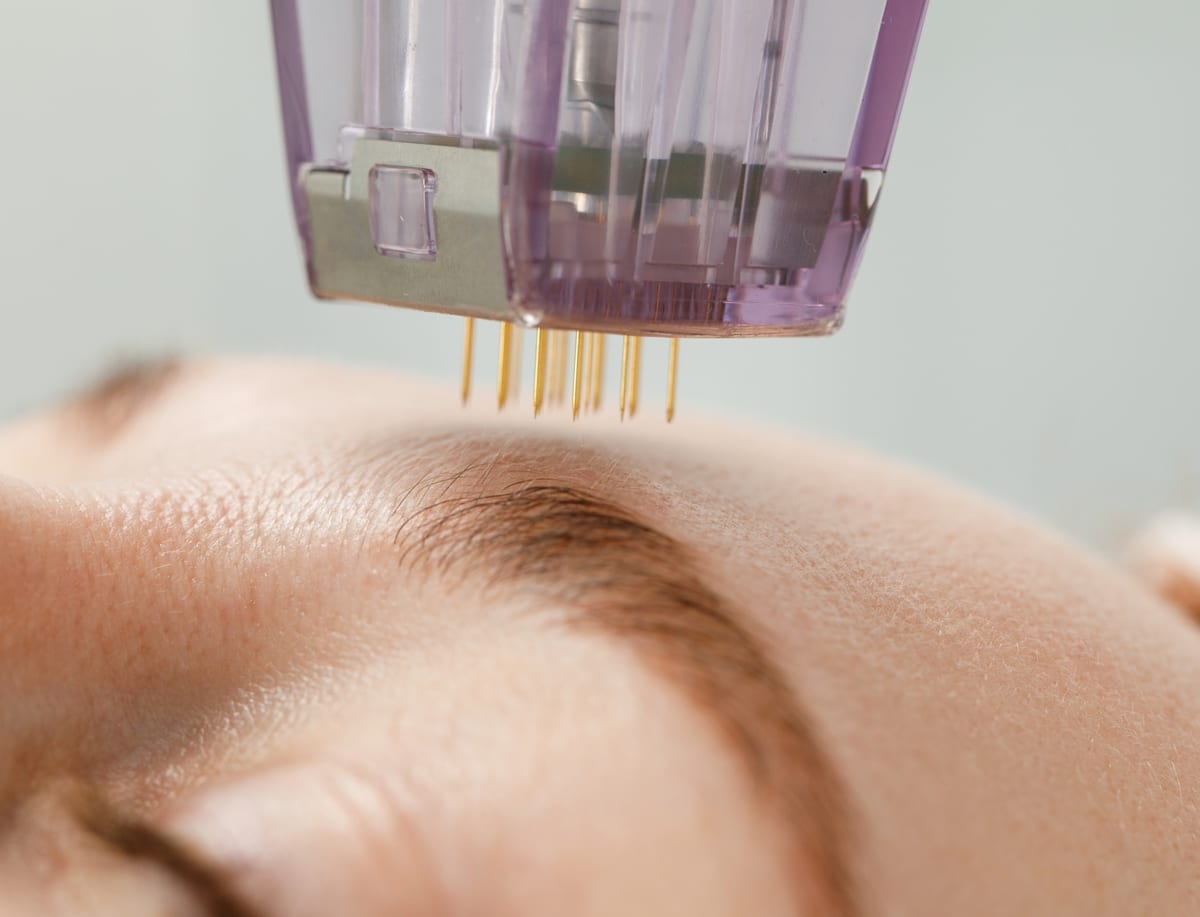 Microneedling & Fruchtsäure-Peeling bei SURI BEAUTY